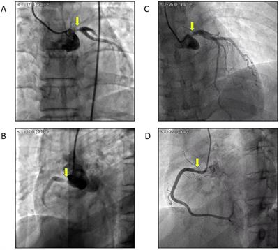 A case report of Cogan's syndrome with recurrent coronary stenosis